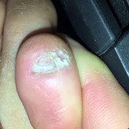 lil Toenail