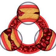 DisLipidemia