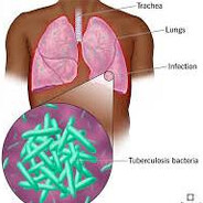 ✈ Tuberculosis PEEK enjoyer