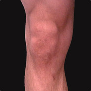 KneeGrow