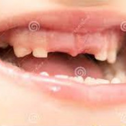 Sem dentes da frente