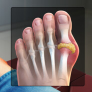 gout