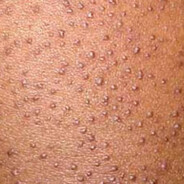 Keratosis pilaris