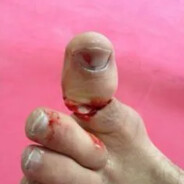 Toe Splitter